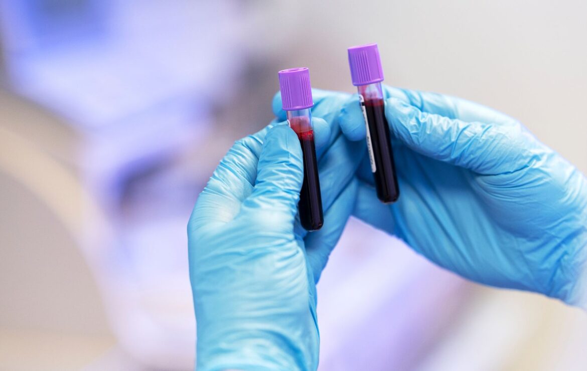Diabetes: qual o papel dos exames laboratoriais no seu diagnóstico e monitoramento?