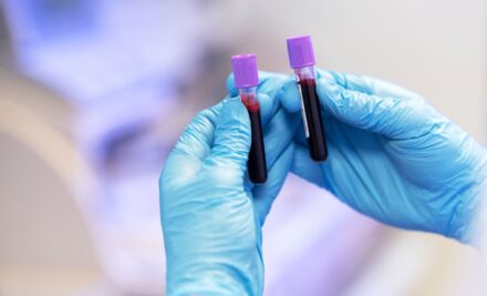 Diabetes: qual o papel dos exames laboratoriais no seu diagnóstico e monitoramento?