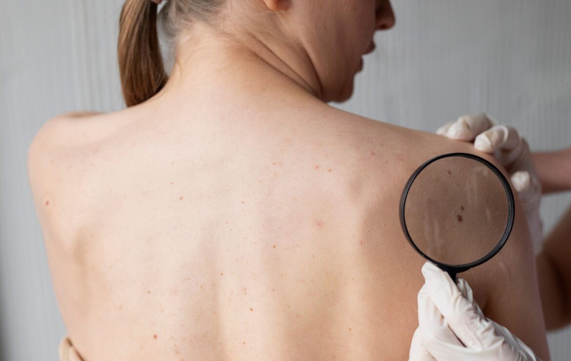 Dezembro Laranja: como prevenir o câncer de pele?