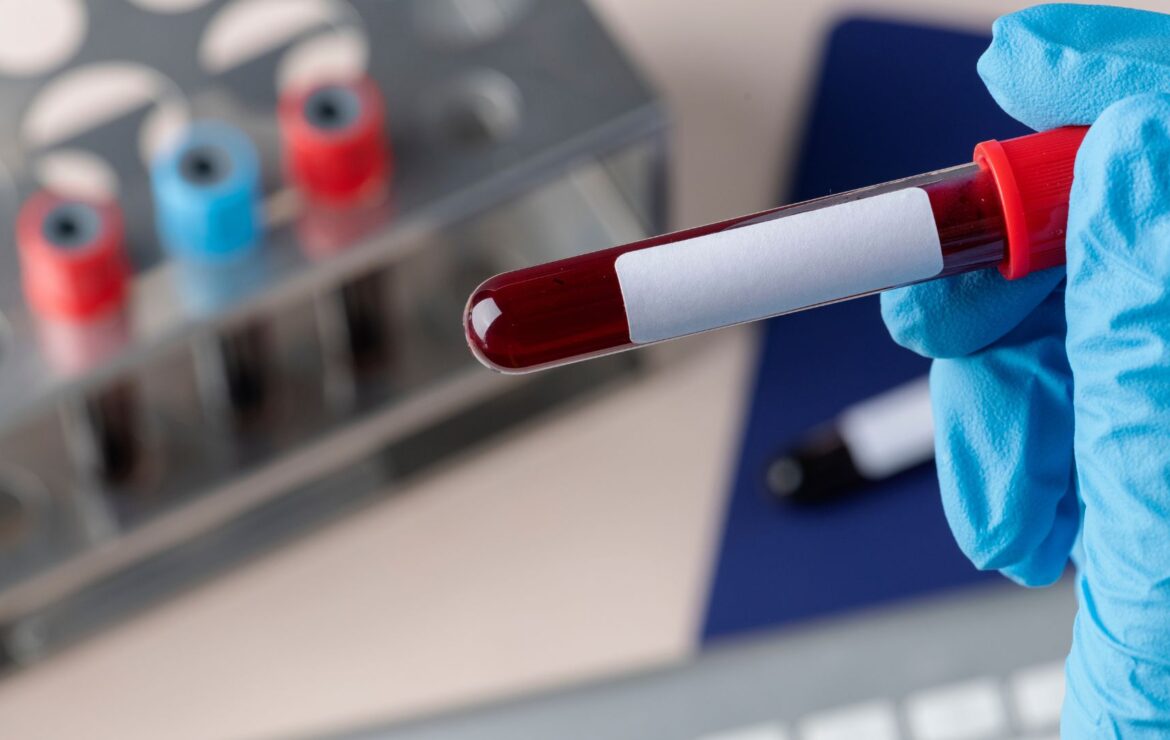 Hepatites Virais: A Importância dos Exames Laboratoriais no Diagnóstico Precoce