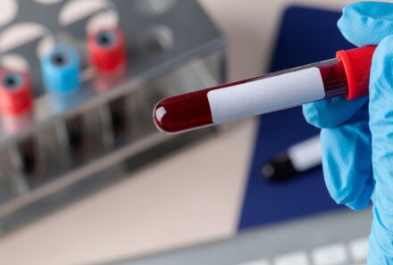 Hepatites Virais: A Importância dos Exames Laboratoriais no Diagnóstico Precoce